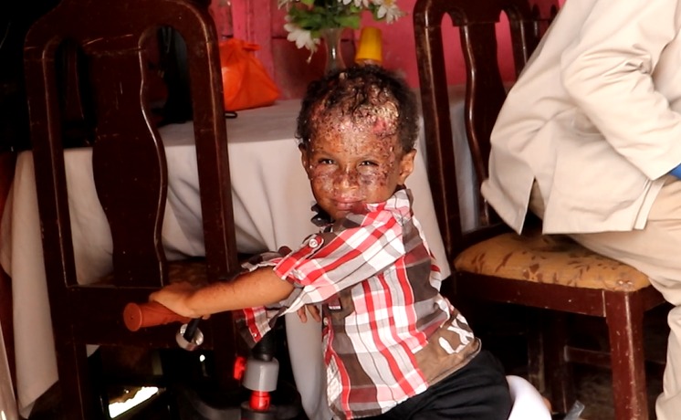 Solicitan ayuda para Ronny, niño que padece Xerodermia Pigmentosa (Enfermedad De La Oscuridad)